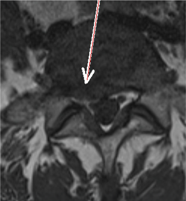 Vor SpineMED Therapie | Diskusprolaps L5/S1